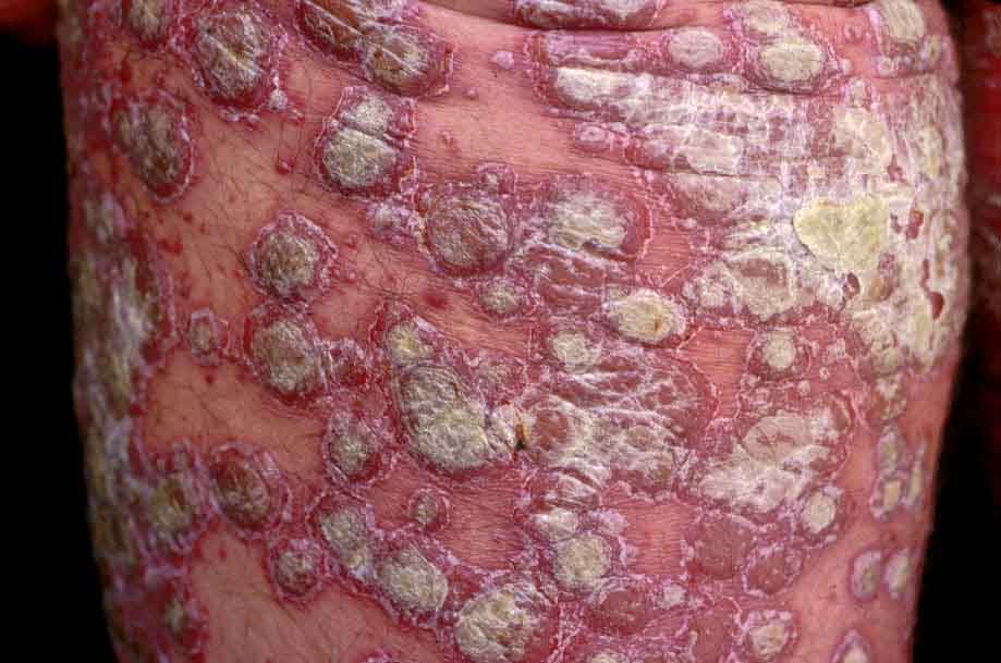 Trattamento della Psoriasi Dermatologica